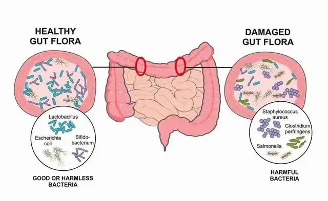 “坏”肠道菌群过多，导致肠道健康状况不佳