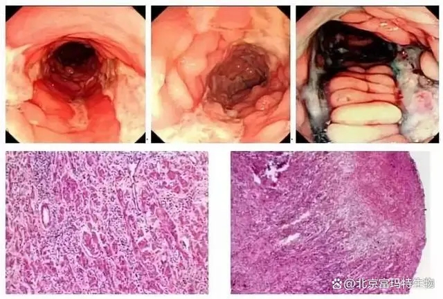 富玛特生物科普——克罗恩能治好吗